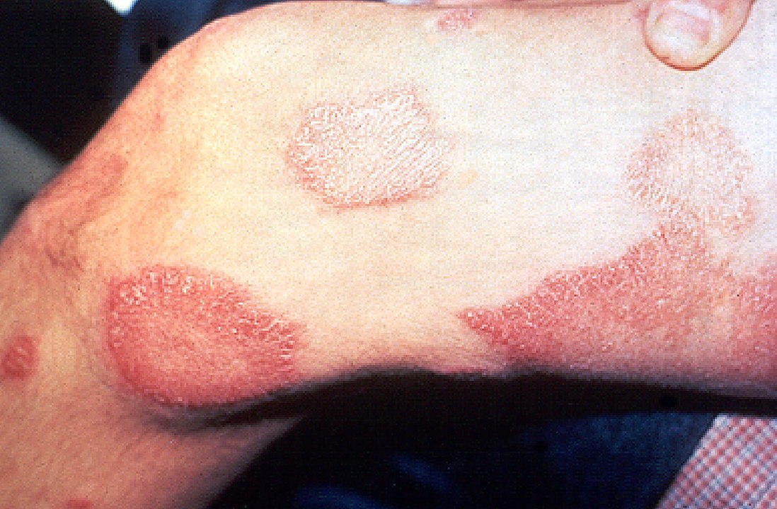Hansen-Krankheit, Lepra. Auf dem Foto ist ein Oberschenkel mit abgegrenzten kutanen Läsionen zu sehen.